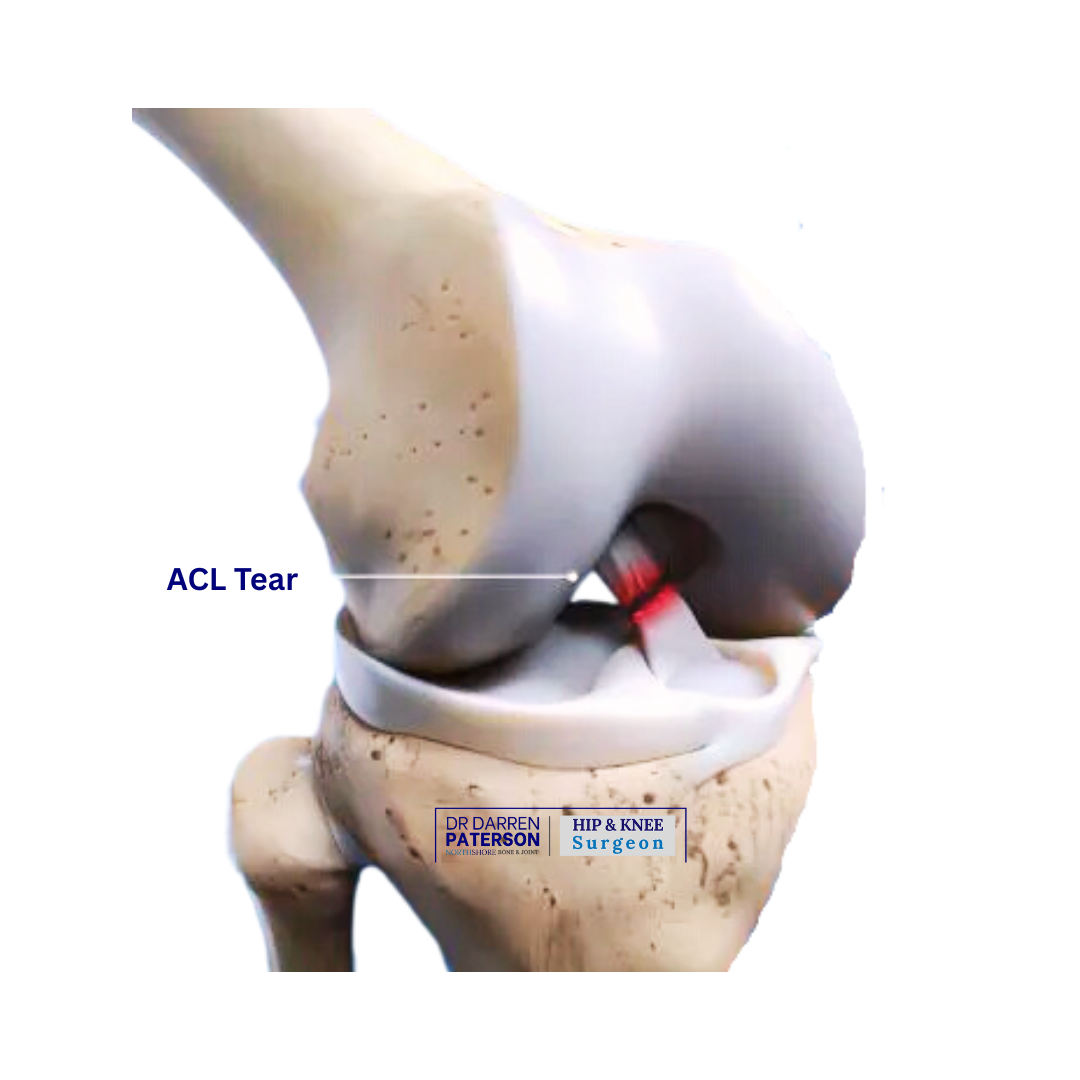 acl tear dr darren paterson