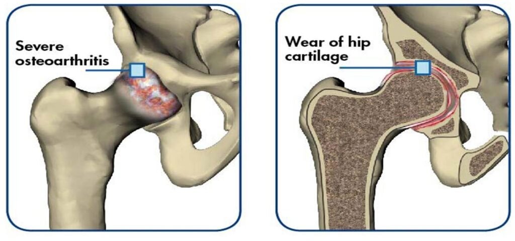 hip arthritis