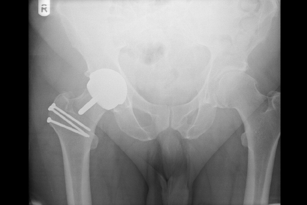 hip resurfacing dr darren paterson