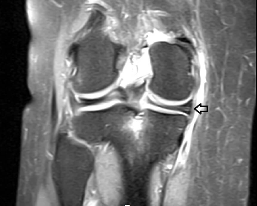 meniscal tear