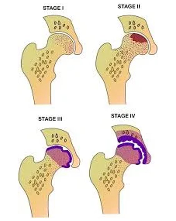 stages of avascular necrosis