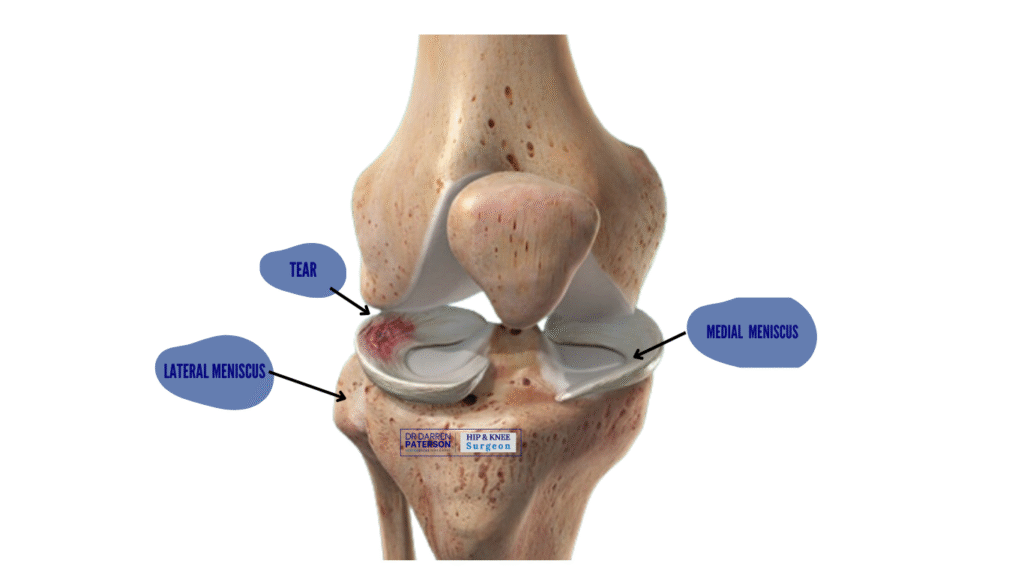 torn meniscus dr darren paterson