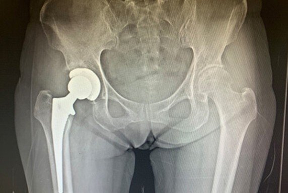 total hip replacement dr darren paterson