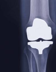 total knee replacement dr darren paterson