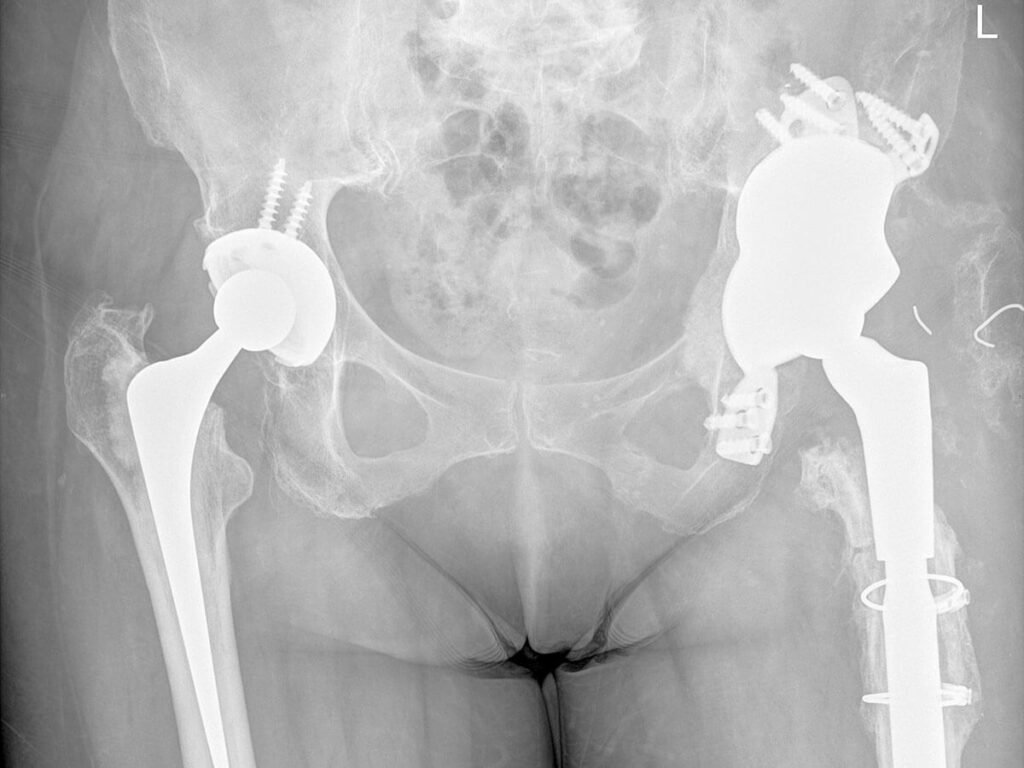 revision total hip replacement dr darren paterson
