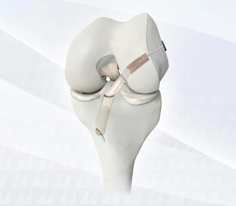 acl recon dr darren paterson