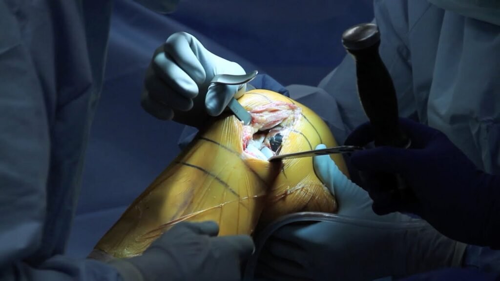 partial knee replacement surgical procedure