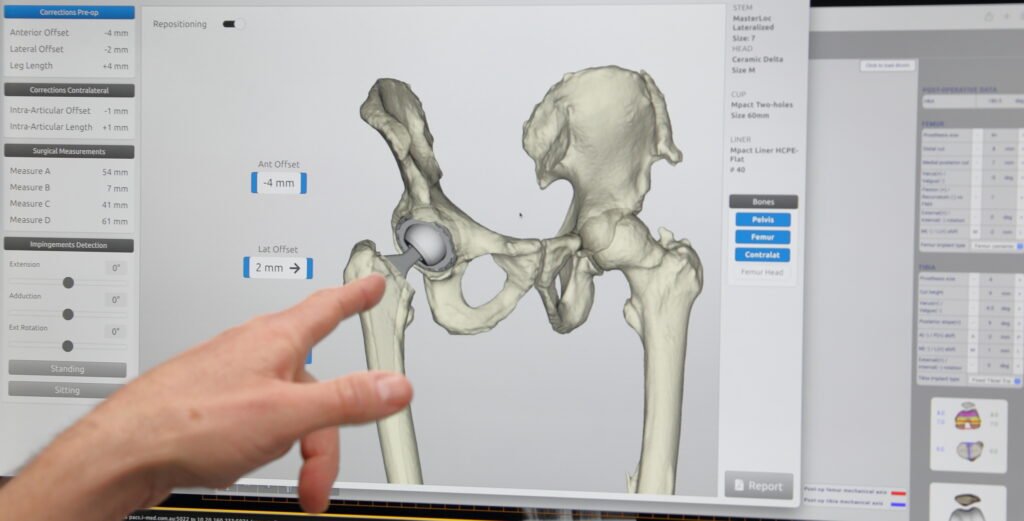 planning software total hip replacement surgery